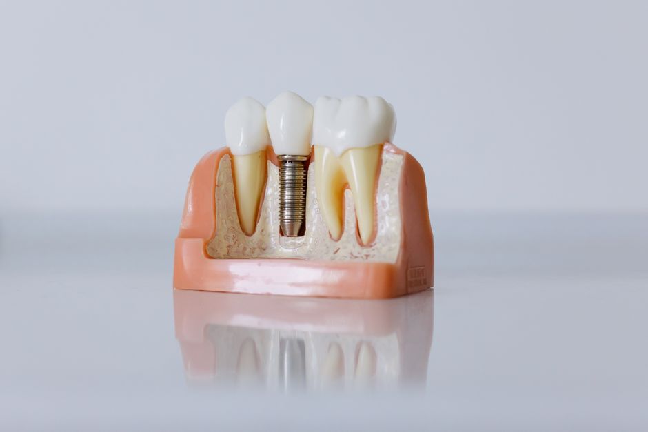 Implantológia